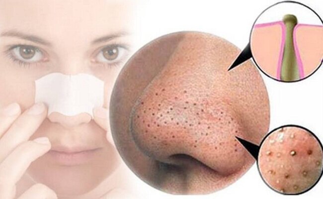 get-rid-of-blackheads-with-these-4-natural-home-remedies